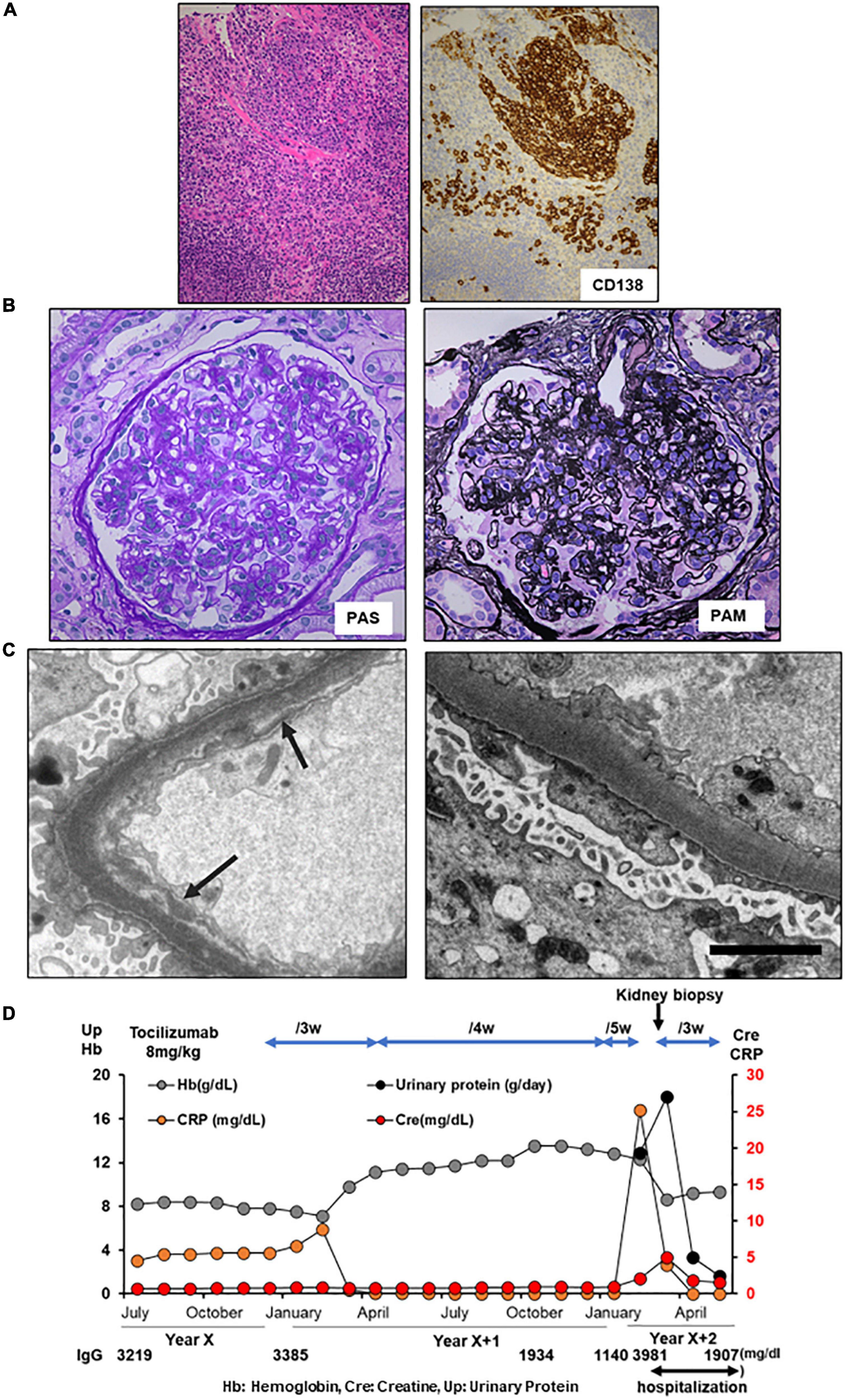 Case report: Importance of early and continuous tocilizumab therapy in nephrotic syndrome associated with idiopathic multicentric Castleman disease: A case series